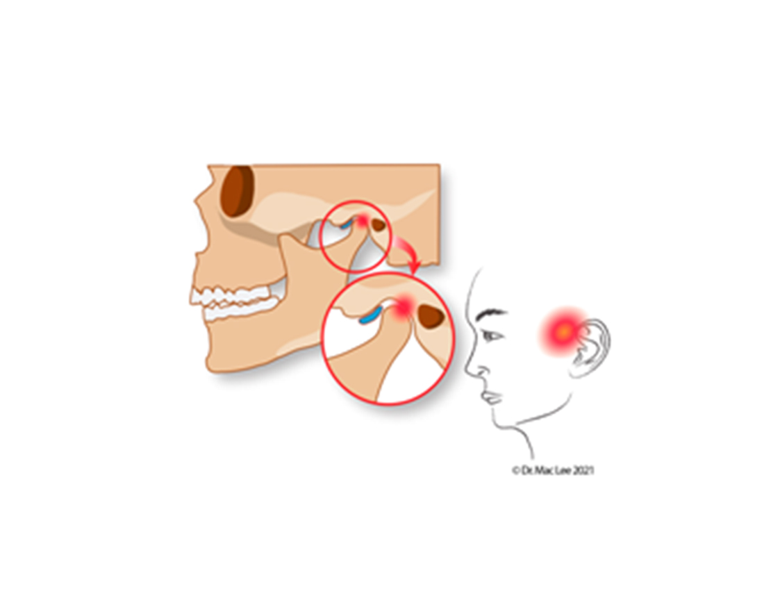 temporomandibular joint disorder,jpg